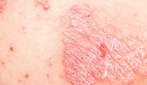 Psoriazė